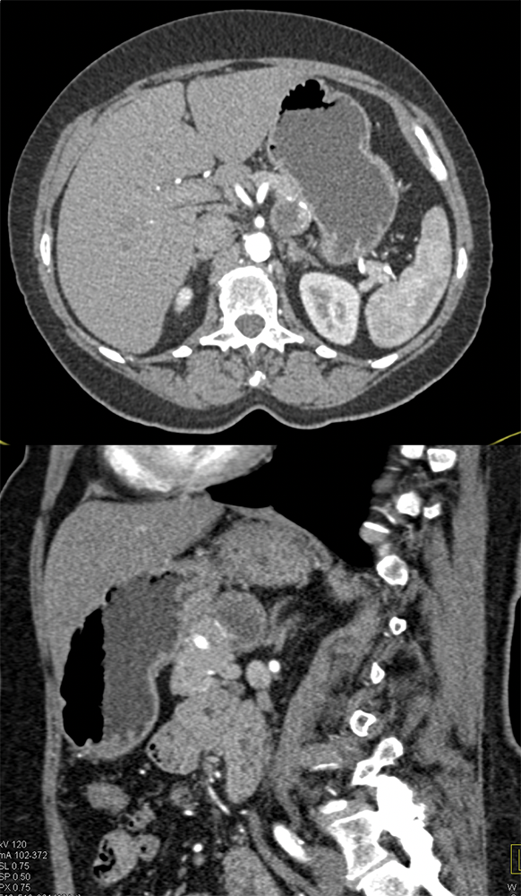 Gastric GIST Tumors