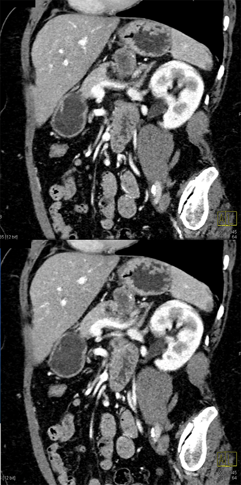 Gastric GIST Tumors