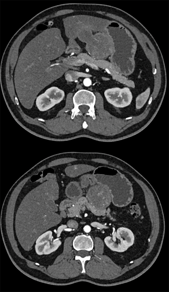 Gastric GIST Tumor --Patient Sent to MDPC