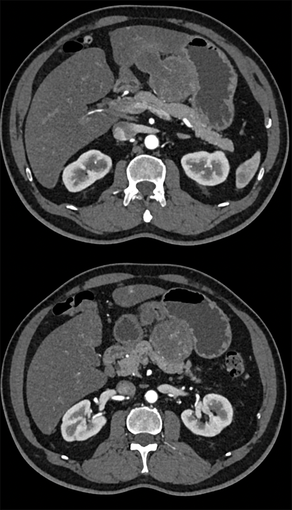 Gastric GIST Tumors