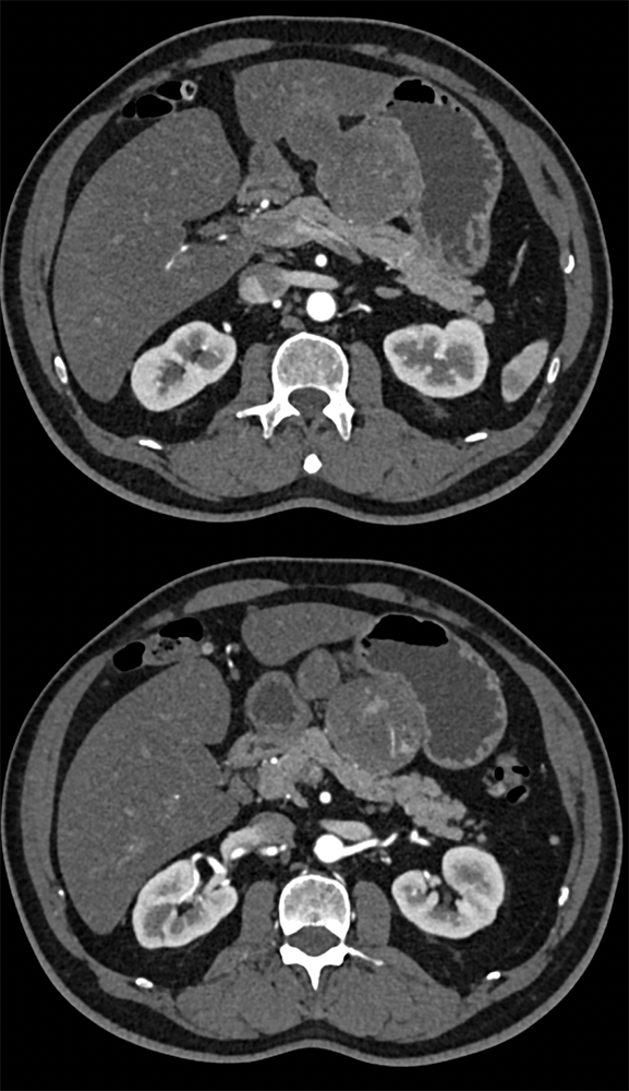 Gastric GIST Tumors