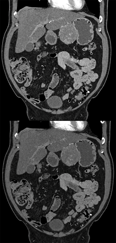 Gastric GIST Tumors