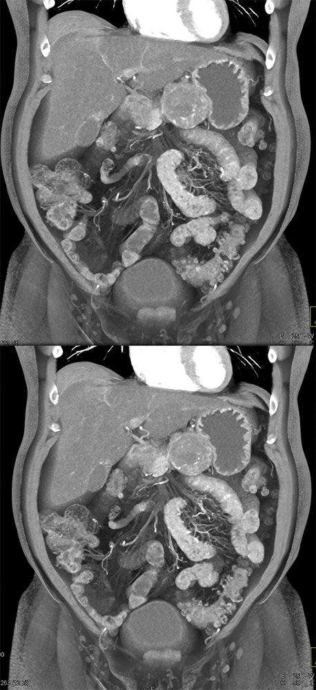 Gastric GIST Tumors