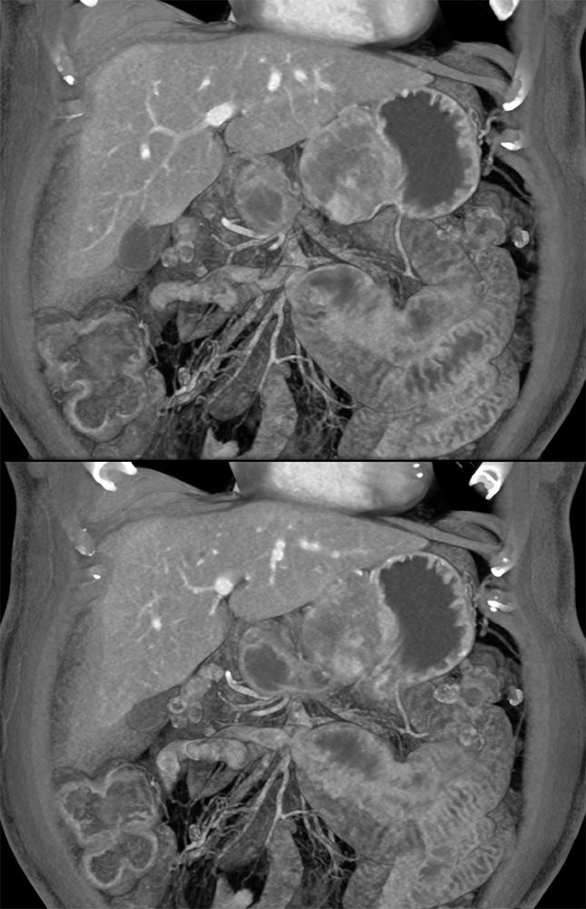 Gastric GIST Tumors