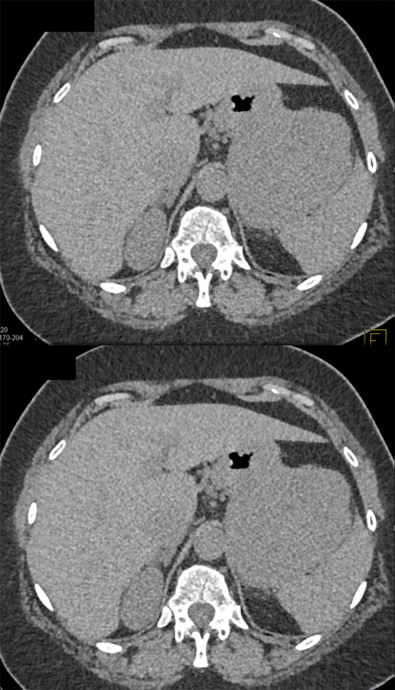 Gastric GIST Tumor Presented as an Adrenal Mass