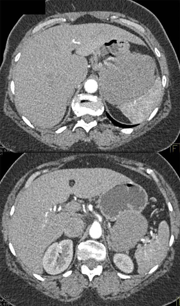 Gastric GIST Tumors