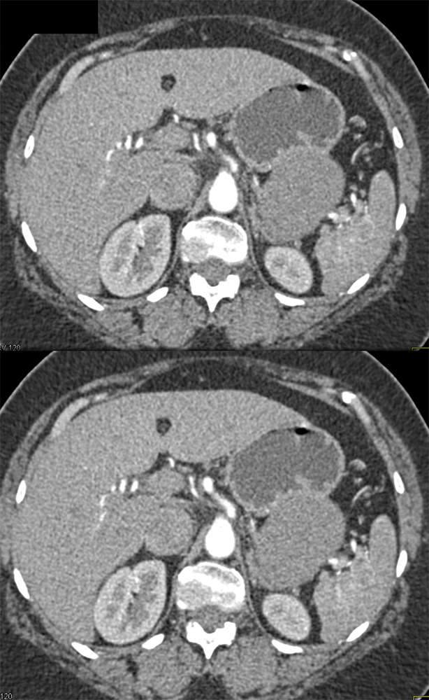 Gastric GIST Tumors