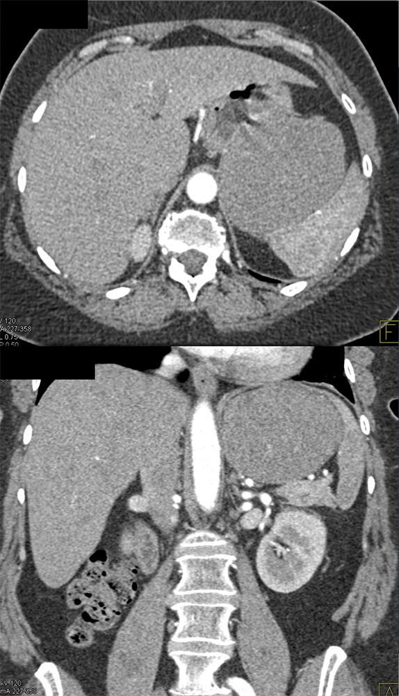 Gastric GIST Tumors