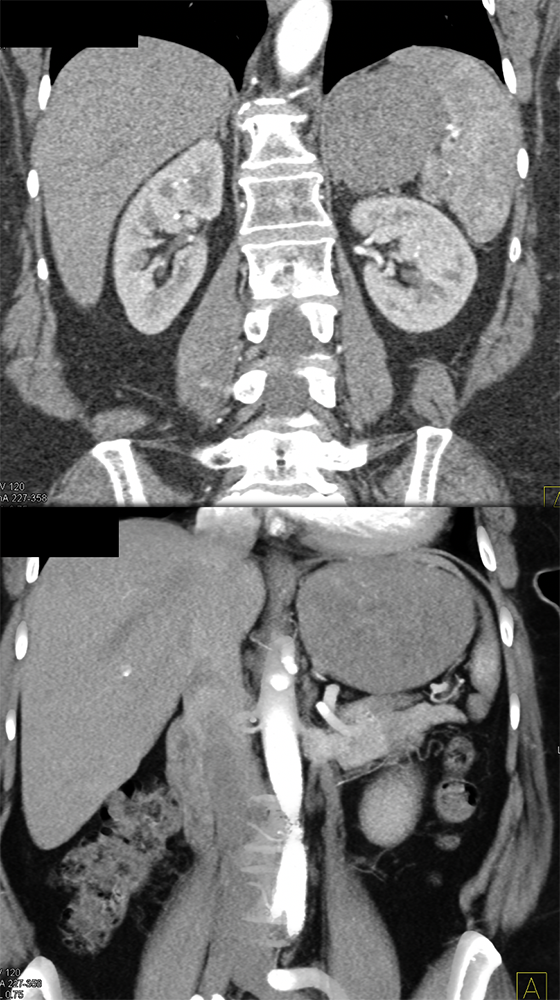 Gastric GIST Tumors