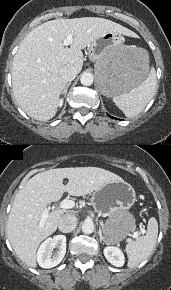 Gastric GIST Tumors