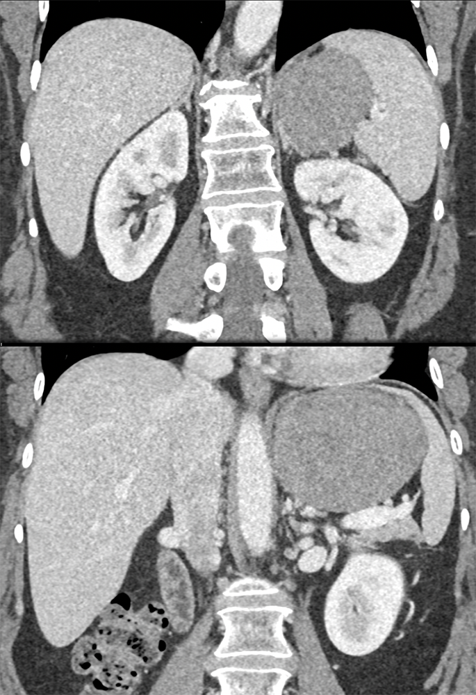 Gastric GIST Tumors