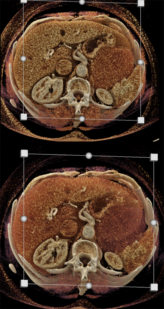 Gastric GIST Tumors