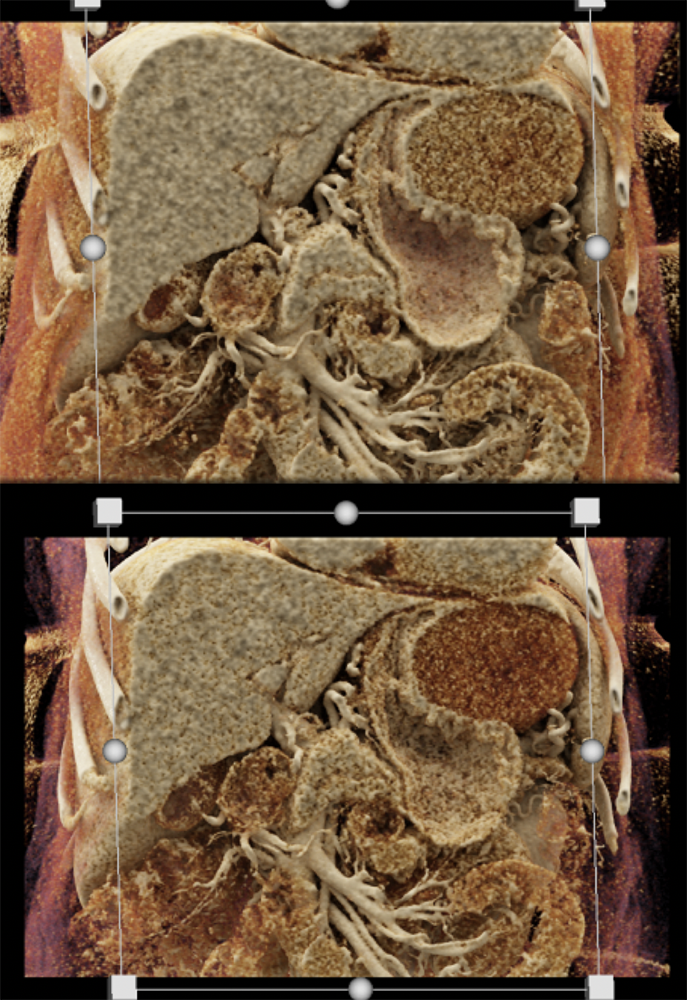 Gastric GIST Tumors