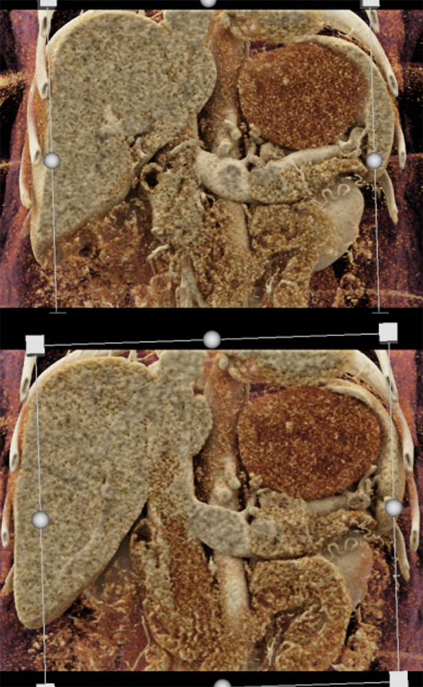 Gastric GIST Tumors