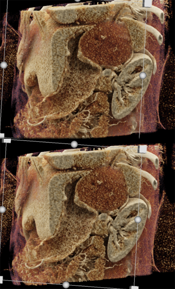 Gastric GIST Tumors