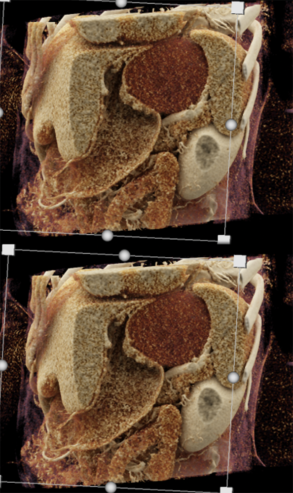 Gastric GIST Tumors