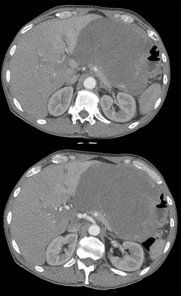 Liposarcoma Invades the Stomach and Looks Like A GIST tumor