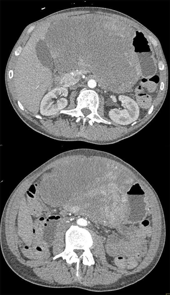 Gastric GIST Tumors