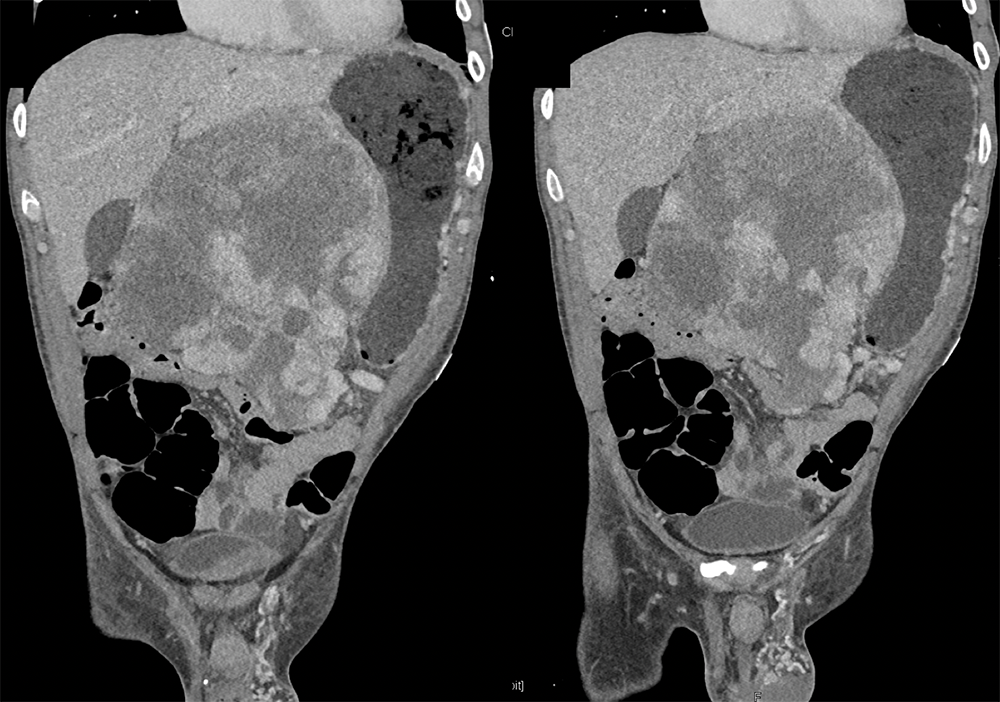 Gastric GIST Tumors