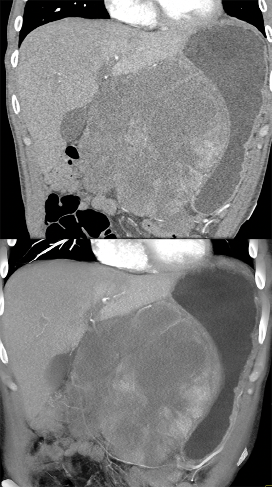 Gastric GIST Tumors