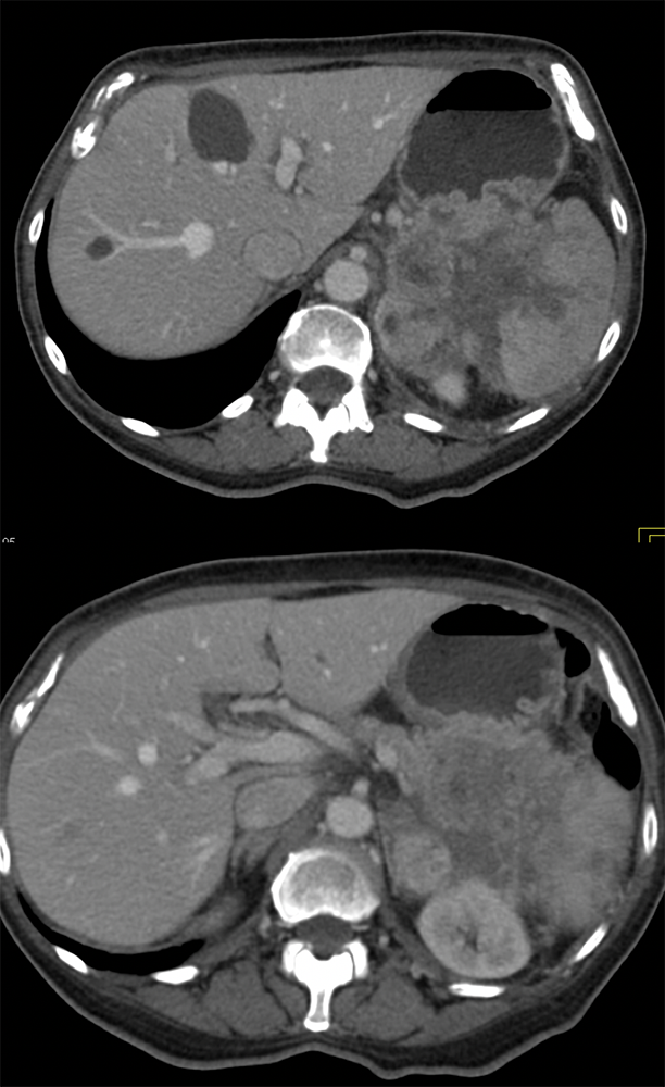 Pancreas Cancer Looks Like GIST and Then Invades Stomach