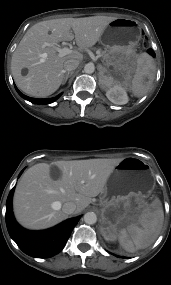 Gastric GIST Tumors