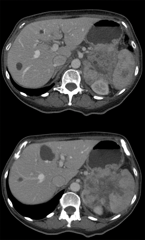 Gastric GIST Tumors