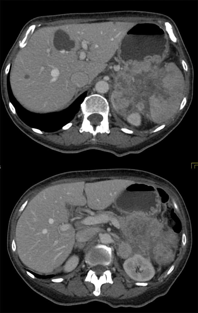 Gastric GIST Tumors