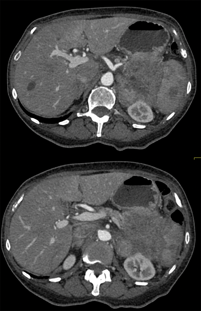 Gastric GIST Tumors