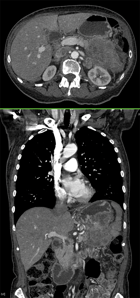 Gastric GIST Tumors