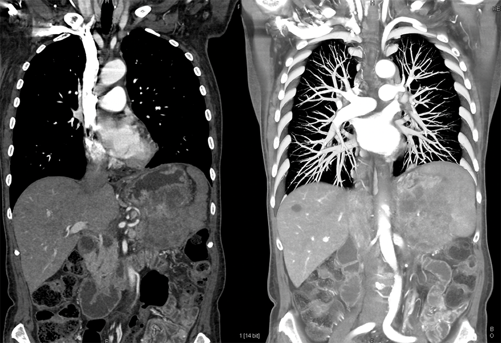 Gastric GIST Tumors