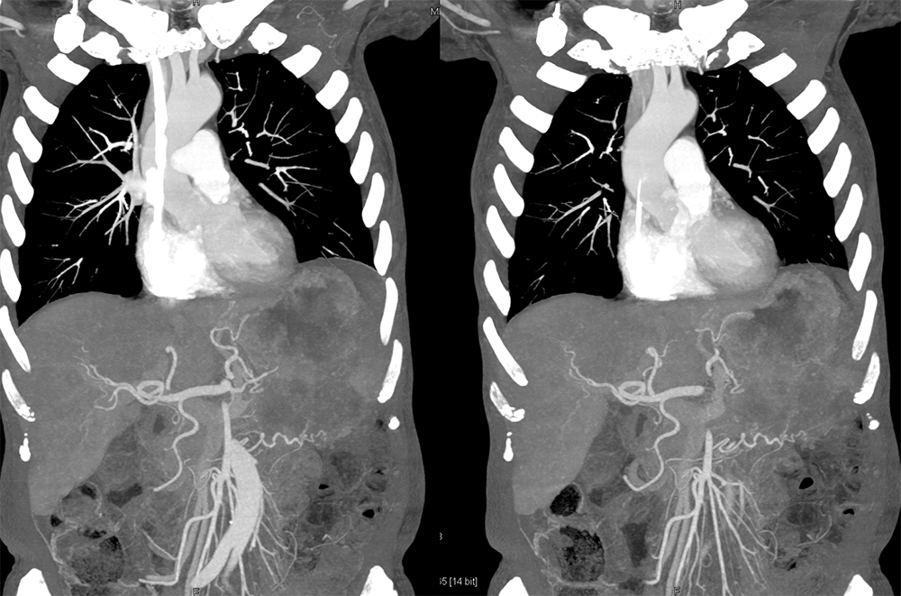 Gastric GIST Tumors