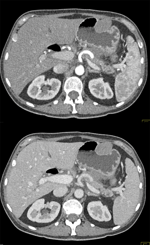 Pancreatic Adenocarcinoma and Gastric GIST Tumor