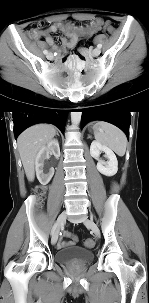 CT of Hematuria