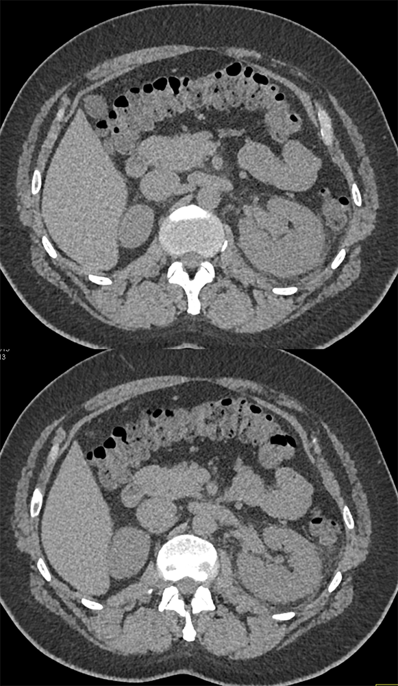 Acute Pyelonephritis