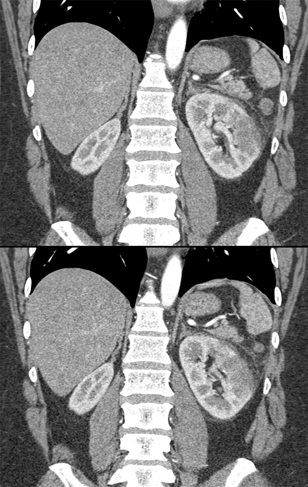 CT of Hematuria