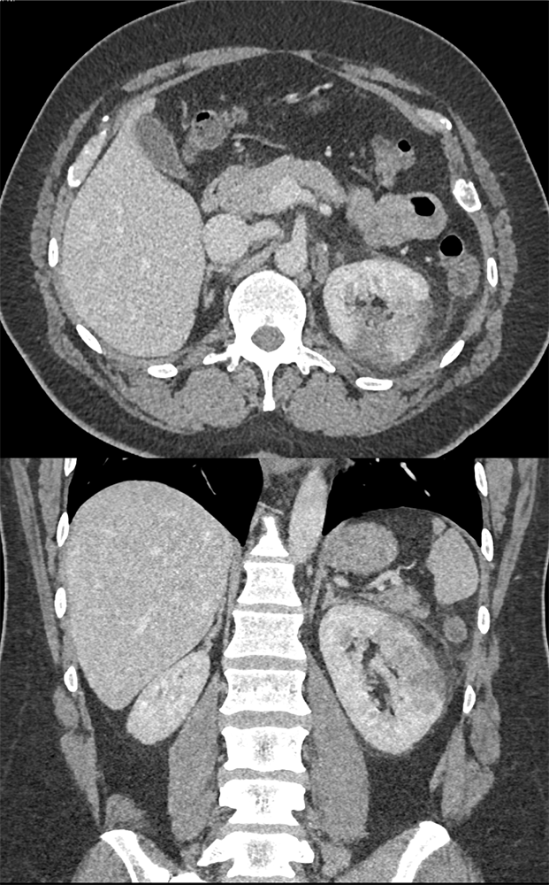 CT of Hematuria