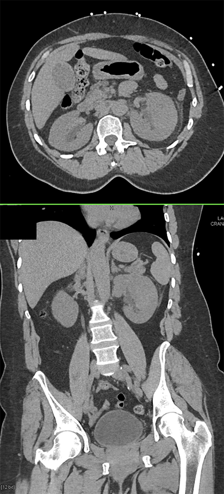 Acute Pyelonephritis(FUO workup)