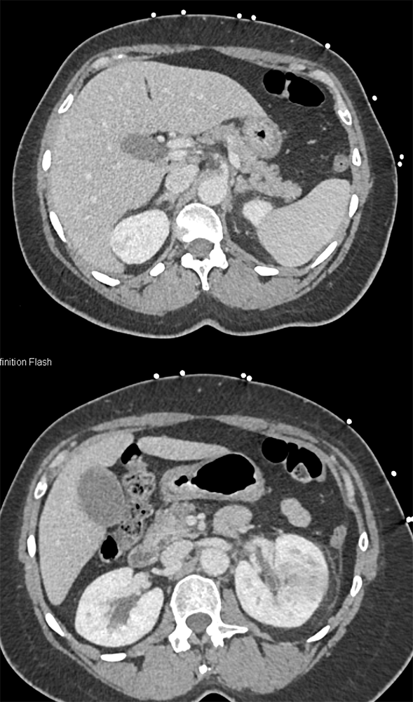 CT of Hematuria