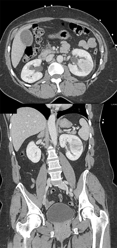 CT of Hematuria