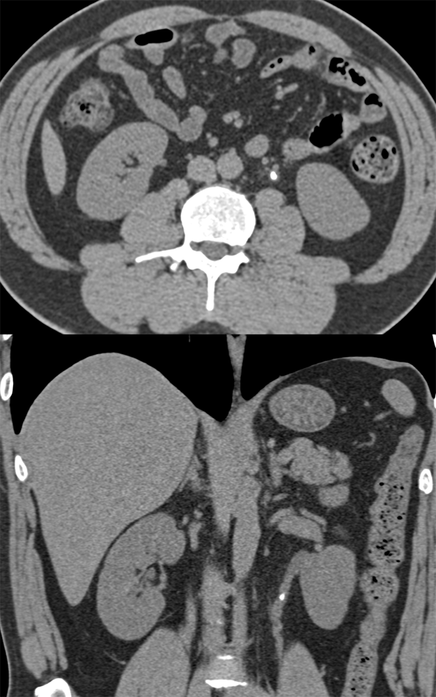 Stone in Ureter