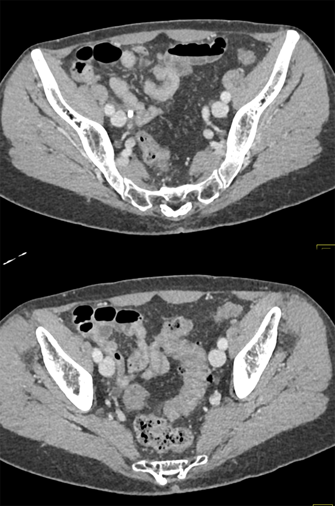 CT of Hematuria