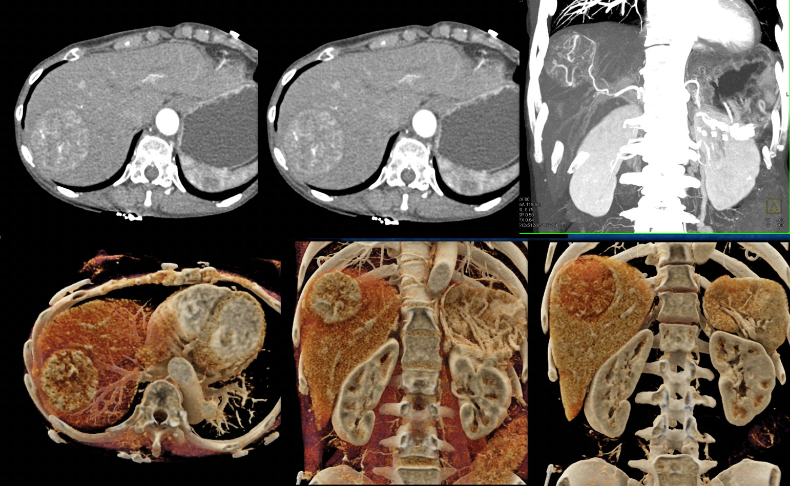 Hepatoma