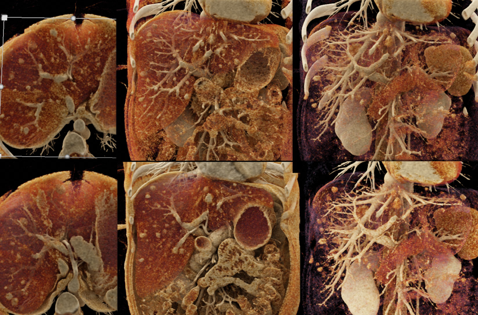 Hepatic Adenomas