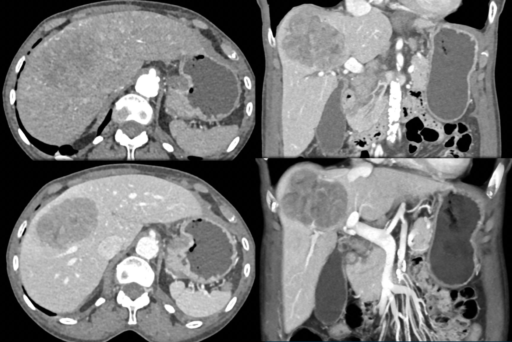 Hepatoma