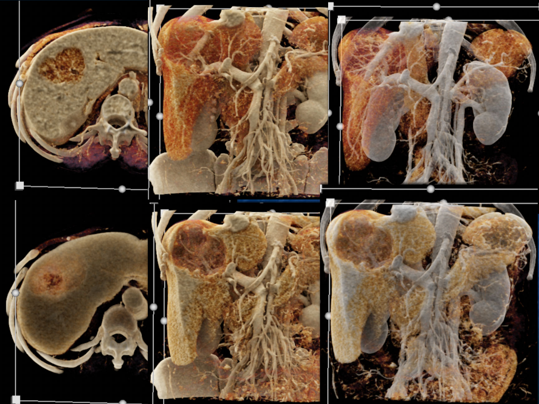 Hepatoma