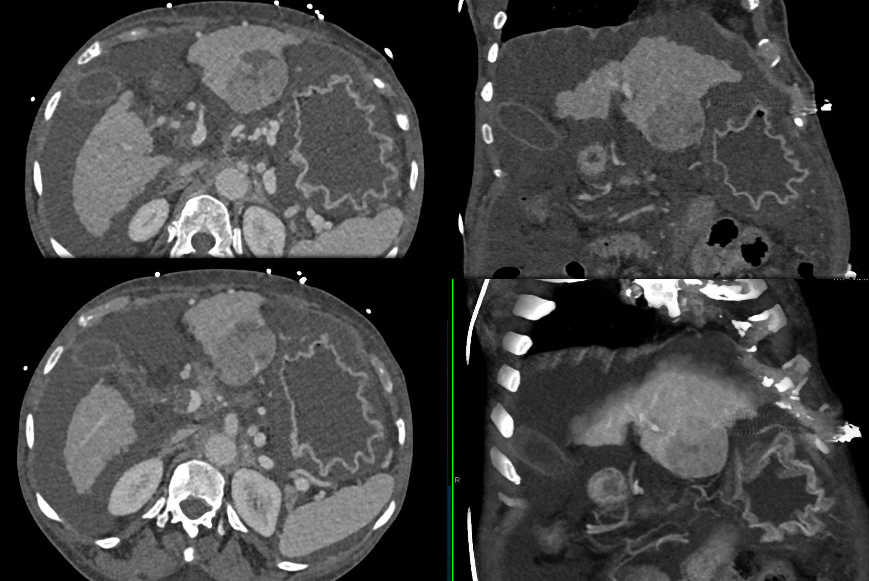 Hepatoma