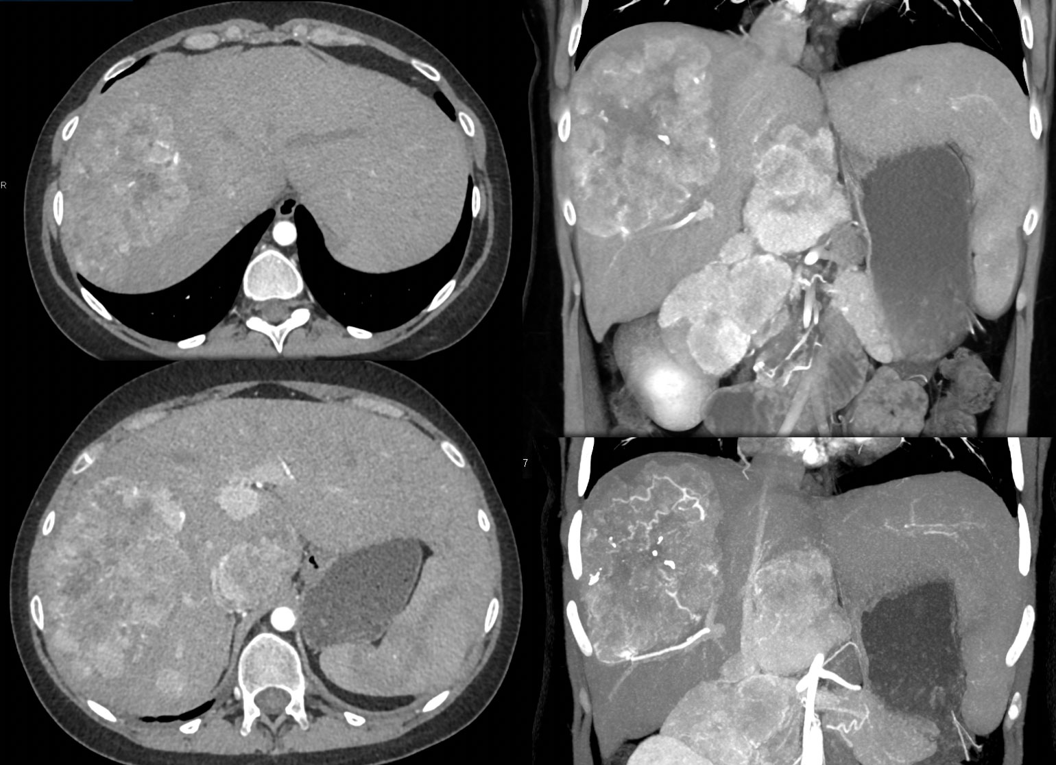 Fibrolamellar HCC in a young female