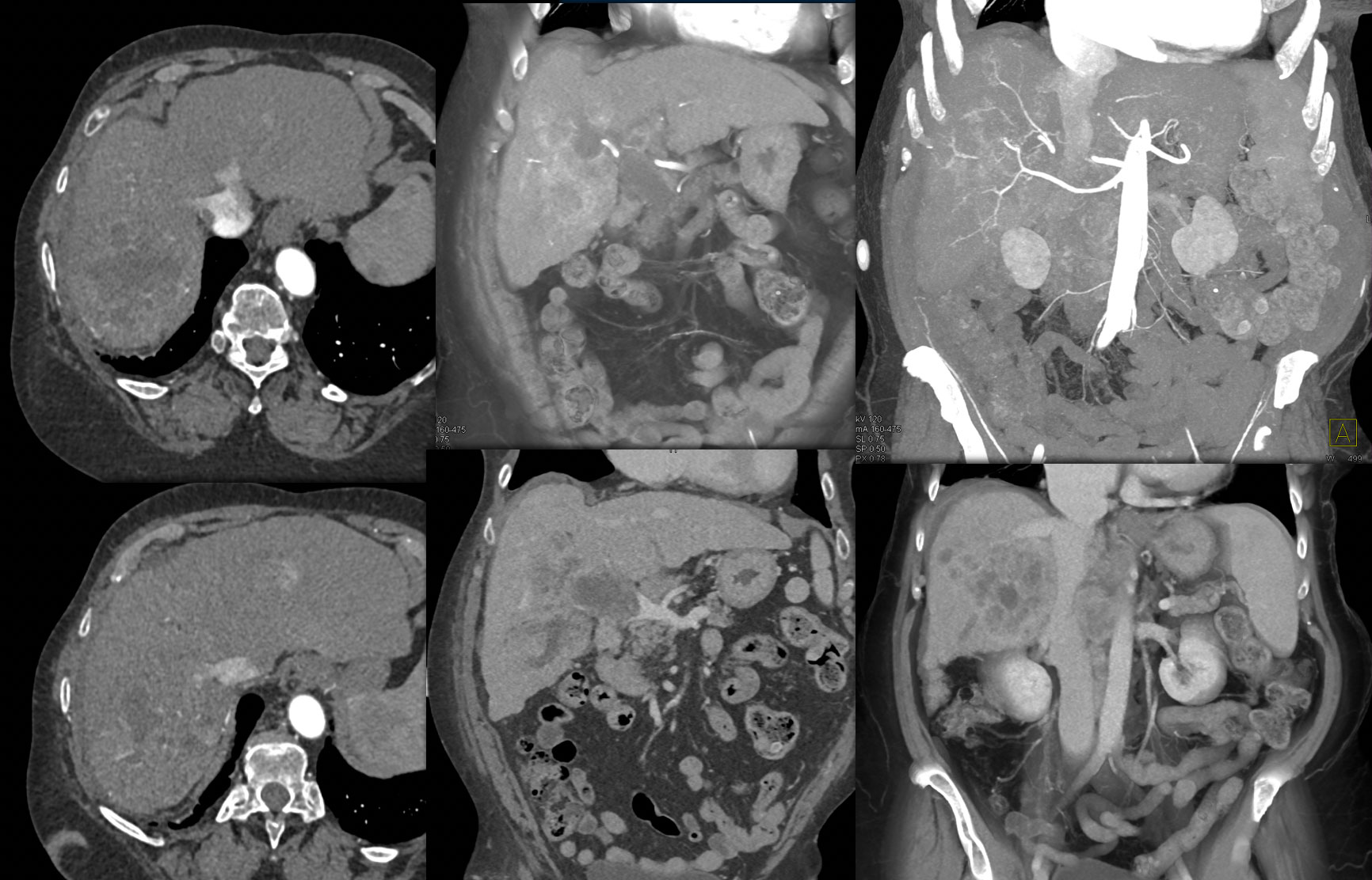 Cholangiocarcinoma