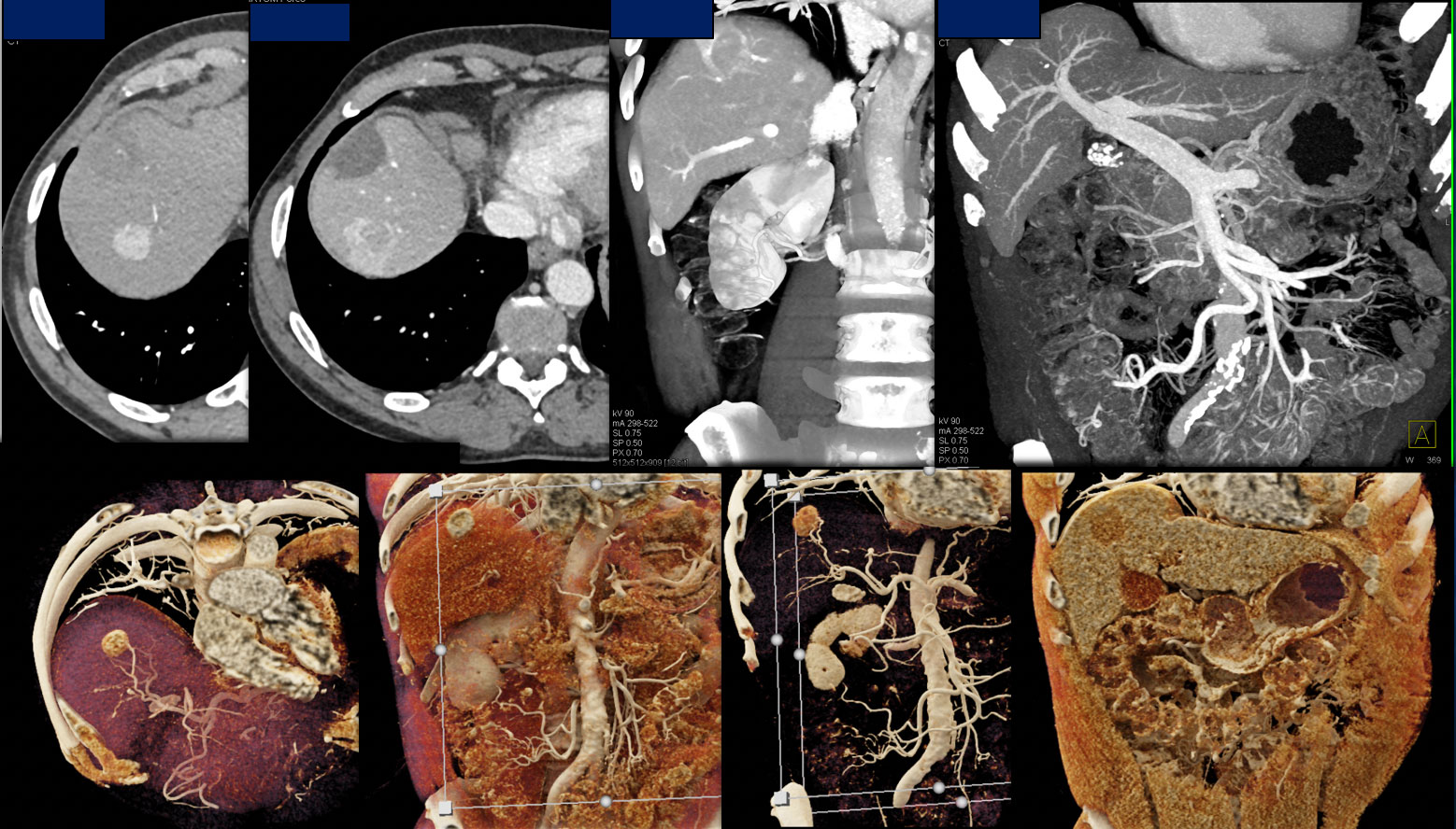 Hepatoma